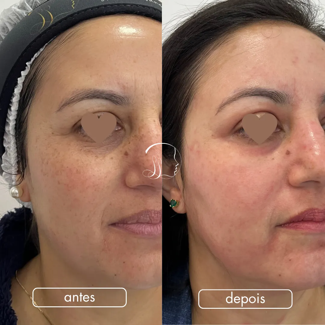Resultado antes e depois 3 com o método D Skin Hard