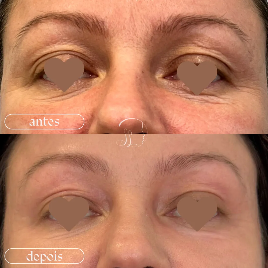Resultado antes e depois 2 com o método D Skin Hard