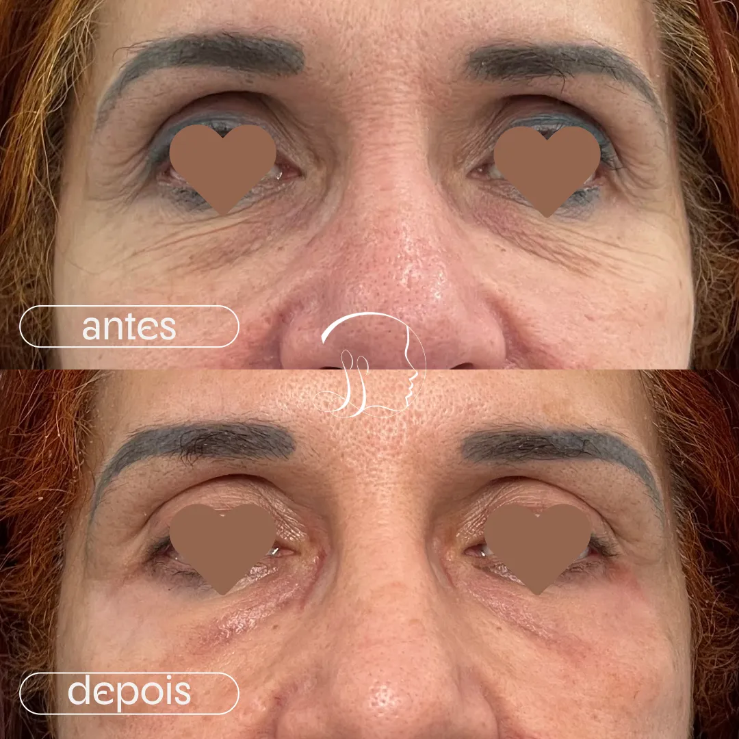 Resultado antes e depois 1 com o método D Skin Hard